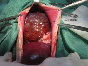 肝臓腫瘍