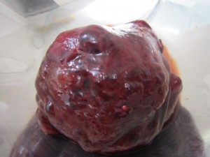 肝臓腫瘍 (2)